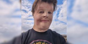 Opekline so iznakazile njegovo telo, ne pa tudi njegove volje do življenja