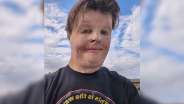 Corner Item Image - Opekline so iznakazile njegovo telo, ne pa tudi njegove volje do življenja